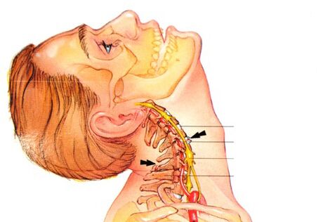 kako izgleda osteohondroza vratne hrbtenice