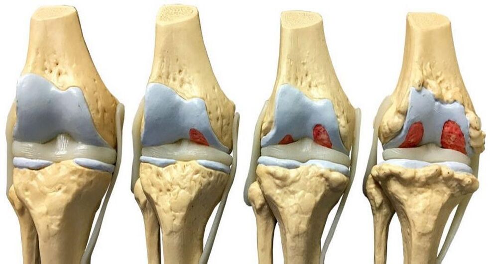 Faze razvoja artroze kolenskega sklepa