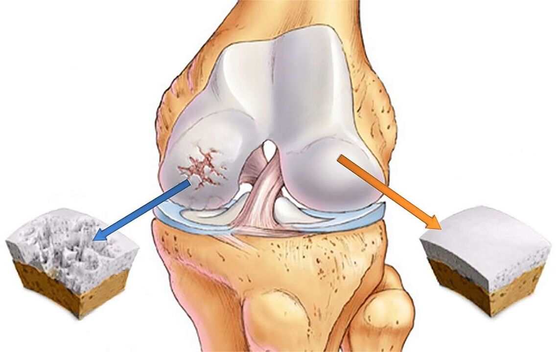 Uničenje hrustanca kolenskega sklepa z gonartrozo
