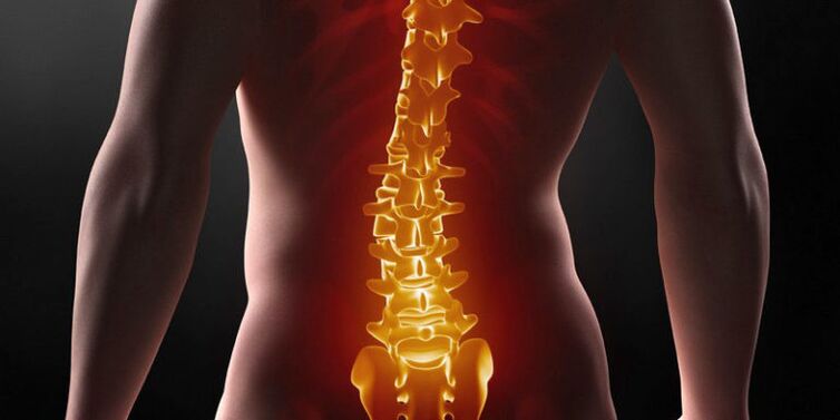 Neprijetne bolečine v spodnjem delu hrbta - simptom III stopnje ledvene osteohondroze