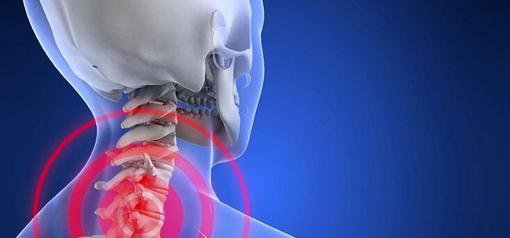 Osteohondroza vratne hrbtenice
