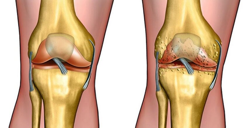 zdrav sklep in artroza kolenskega sklepa